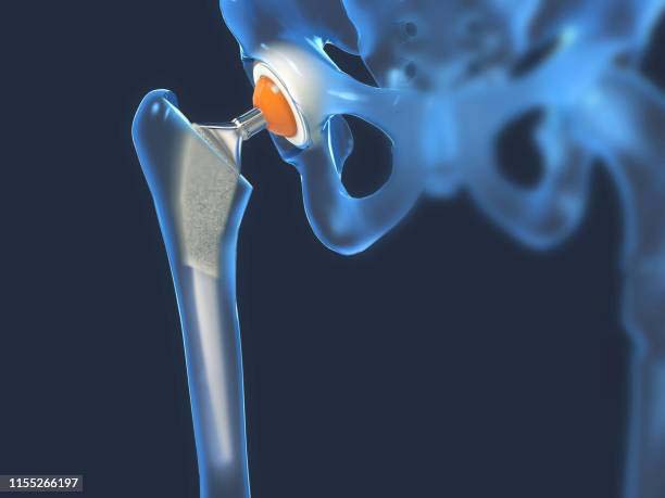 Human Implants